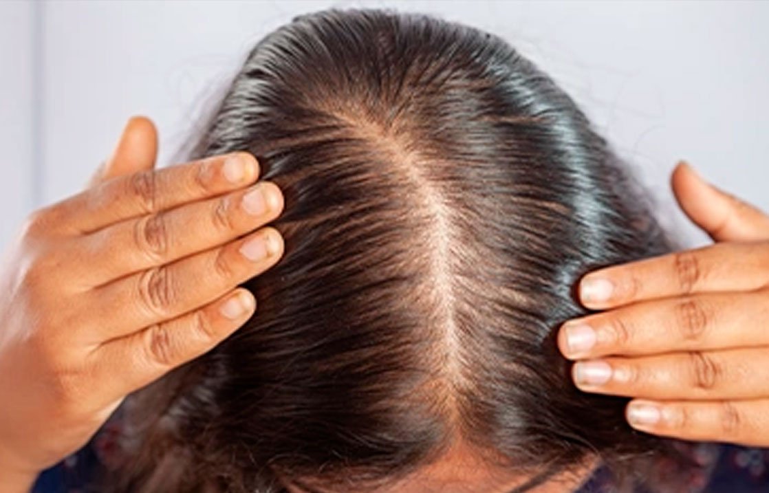 alopecia. hair loss
