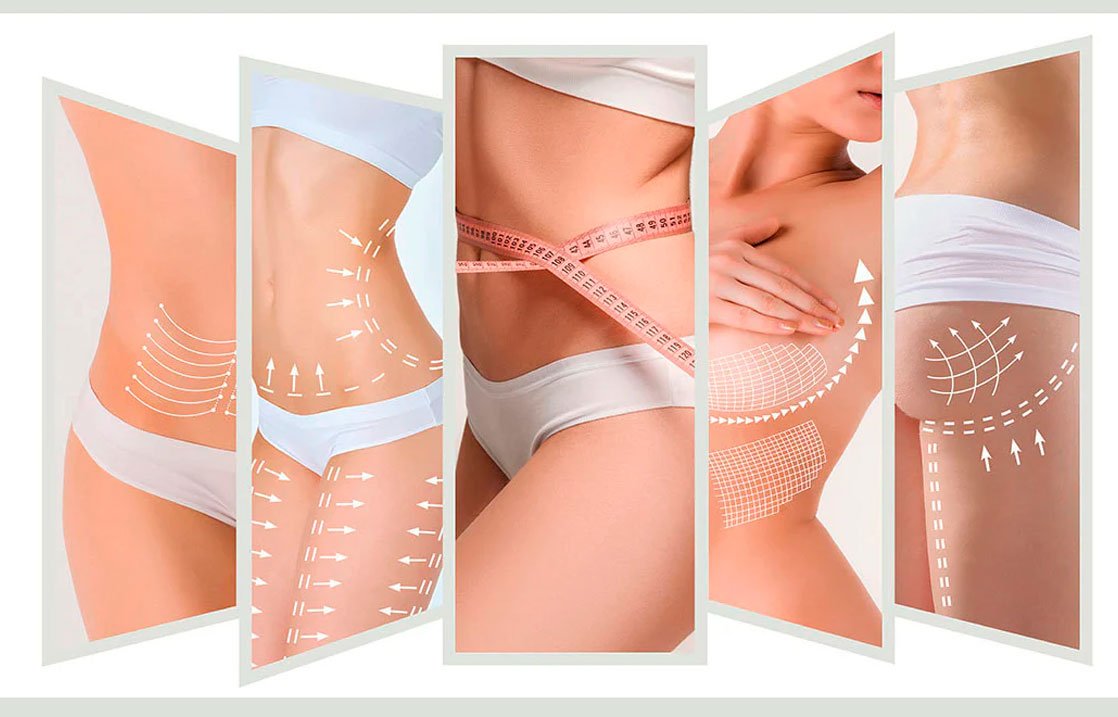 Lipolytic mesotherapy